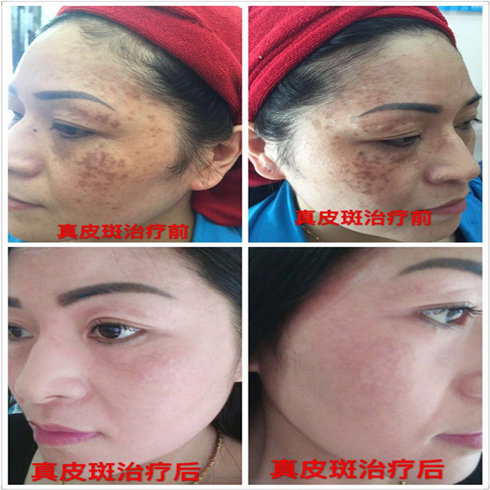 铭钰祛斑祛痘效果图7