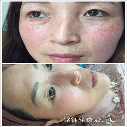 铭钰祛斑祛痘效果图6