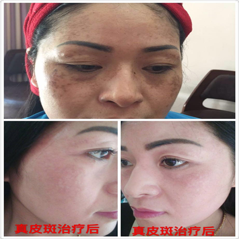 铭钰祛斑祛痘效果图5