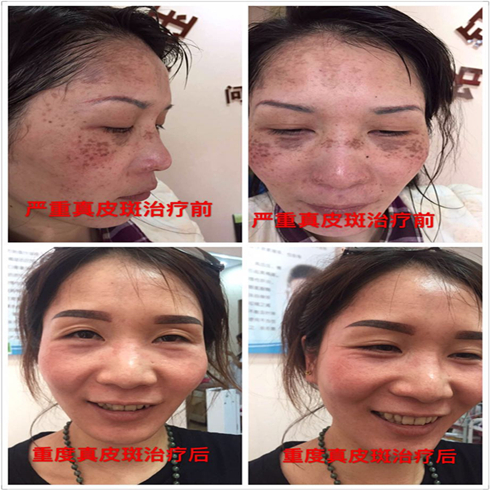 铭钰祛斑祛痘效果图4