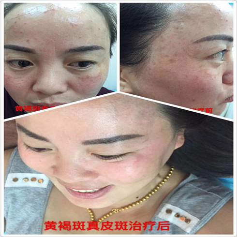 铭钰祛斑祛痘效果图3
