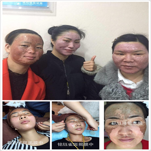 铭钰祛斑祛痘效果图2