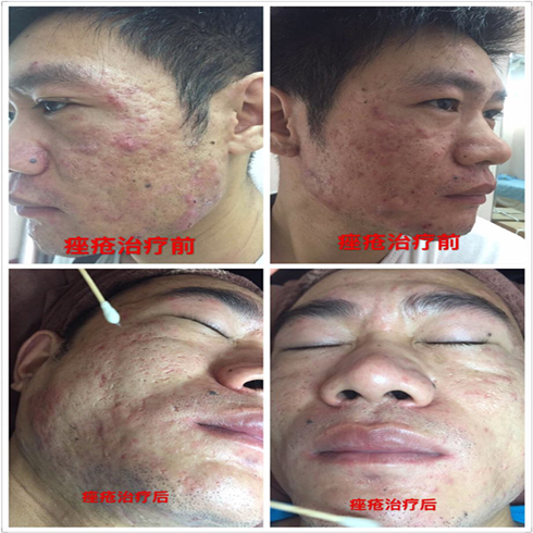 铭钰祛斑祛痘效果图